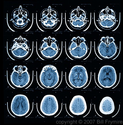 MRI